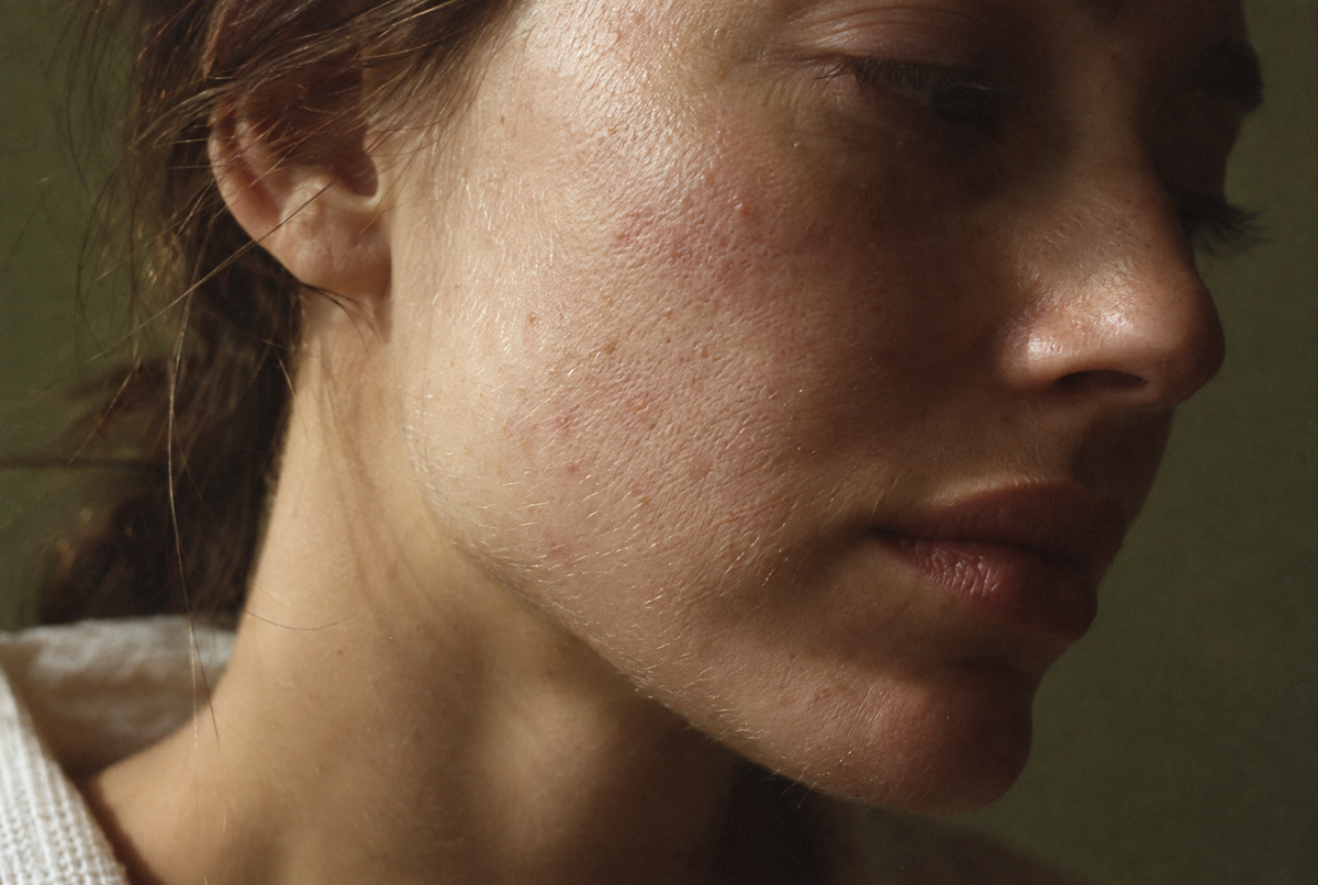 How to repair a damaged skin barrier